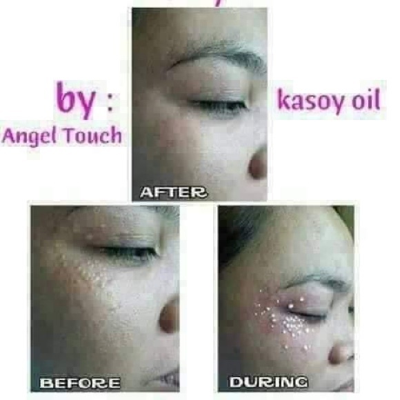 Kasoy Cream by Angel Touch skin tag keloid milia - Picture 8 of 9